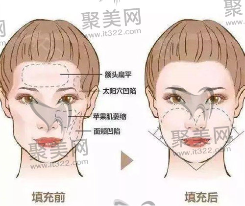 苹果肌填充 苹果肌填充