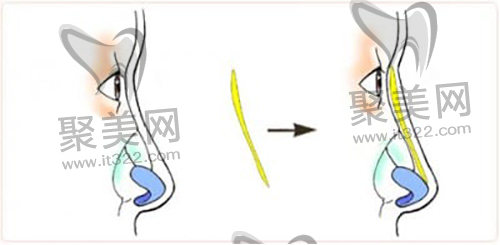隆鼻前后对比 隆鼻前后对比