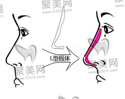隆鼻前后对比 隆鼻前后对比