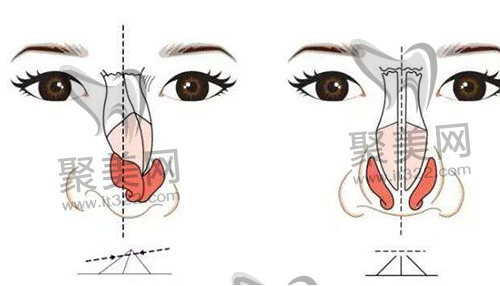 隆鼻手术 隆鼻手术