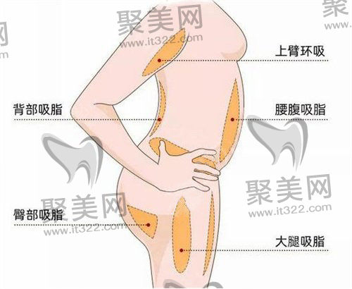 吸脂 吸脂