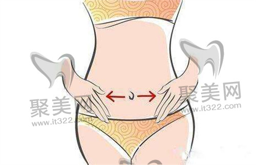 吸脂手术 吸脂手术