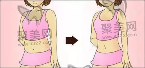 吸脂手术 吸脂手术