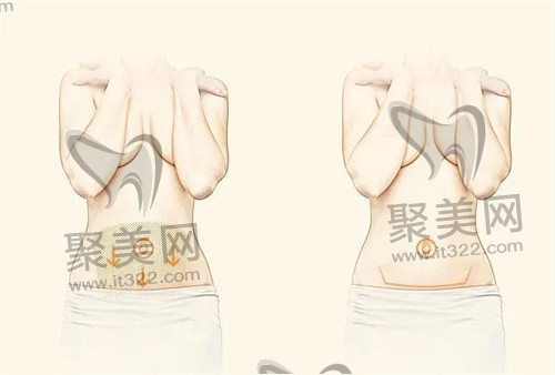 吸脂手术 吸脂手术