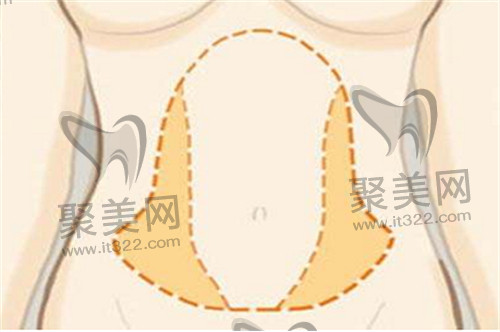 吸脂手术 吸脂手术