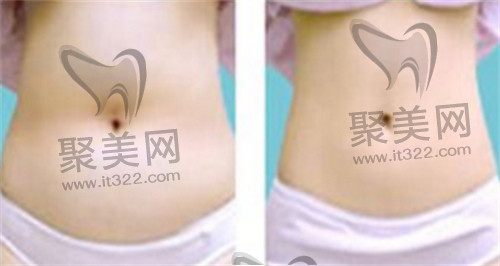 吸脂手术 吸脂手术