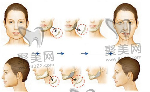 磨骨手术 磨骨手术