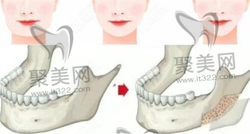 磨骨手术 磨骨手术