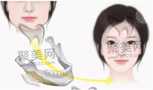 磨骨手术 磨骨手术