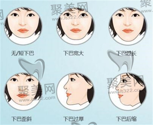 磨骨手术 磨骨手术