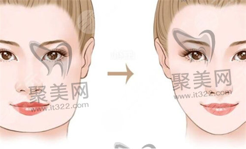 磨骨手术 磨骨手术