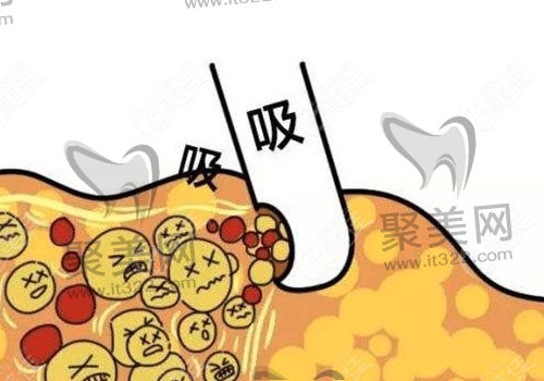 腰腹环吸 腰腹环吸