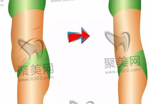 腰腹环吸 腰腹环吸