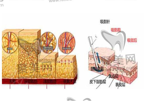 腰腹环吸 腰腹环吸