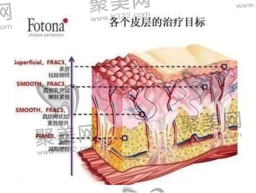 欧洲之星fotona4d抗衰多久做一次? 欧洲之星fotona4d抗衰多久做一次?