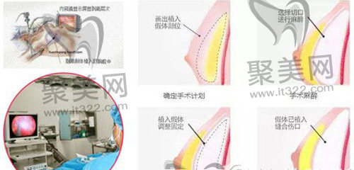 隆胸手术 隆胸手术