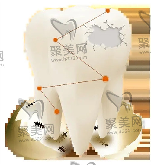 补牙 补牙