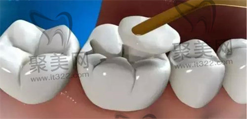 补牙 补牙