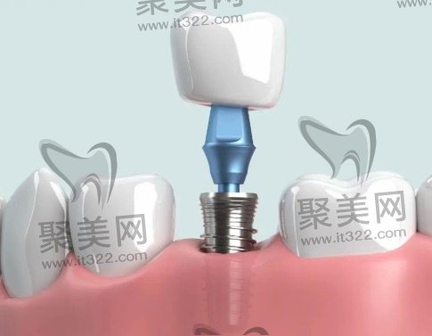 种植体选择价格越贵的就越好吗? 种植体选择价格越贵的就越好吗?