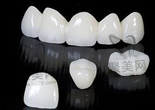 牙贴面 牙贴面
