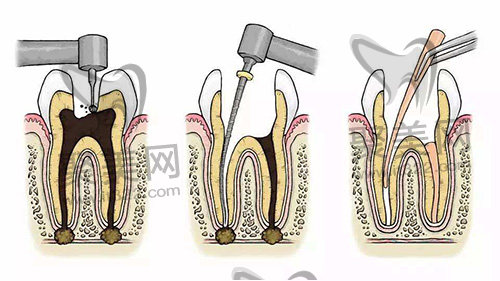 根管治疗 根管治疗