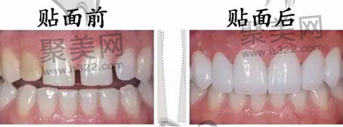 贴面前后对比 贴面前后对比