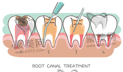 根管治疗 根管治疗