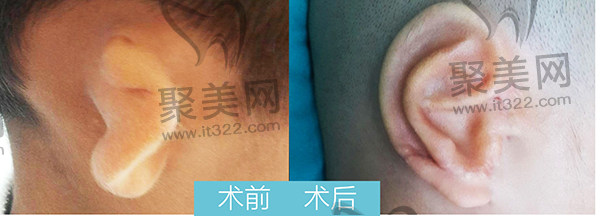 广州高尚整形医院做耳再造修复 广州高尚整形医院做耳再造修复