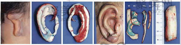 余文林耳朵再造怎么样 余文林耳朵再造怎么样