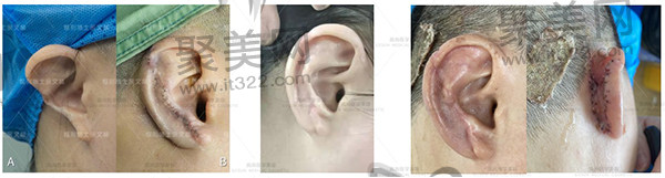 余文林耳朵再造怎么样 余文林耳朵再造怎么样