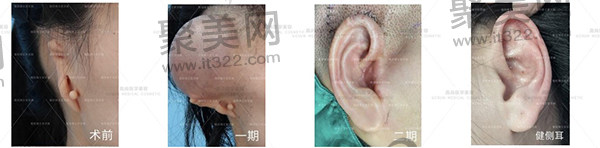 余文林院长做全包法耳再造手术 余文林院长做全包法耳再造手术