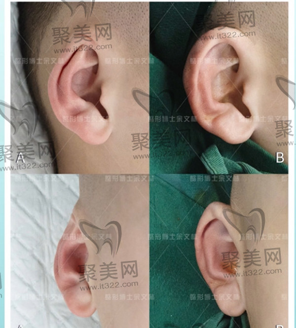 6岁小男孩双侧隐耳矫正 6岁小男孩双侧隐耳矫正