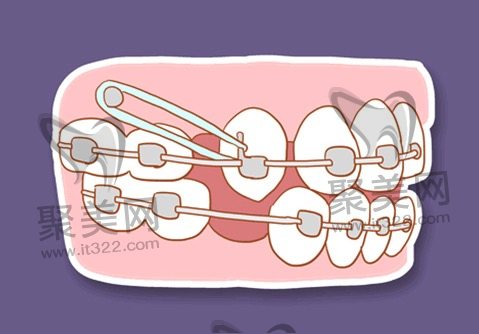 自锁托槽和普通托槽有什么区别? 自锁托槽和普通托槽有什么区别?