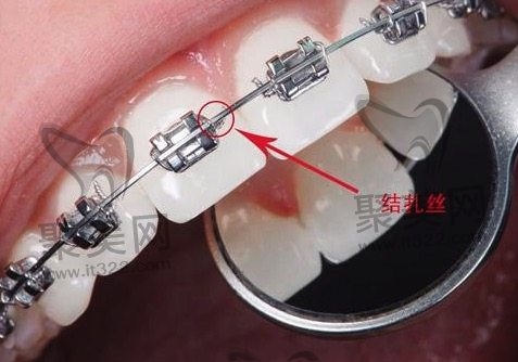 金属托槽矫正 金属托槽矫正