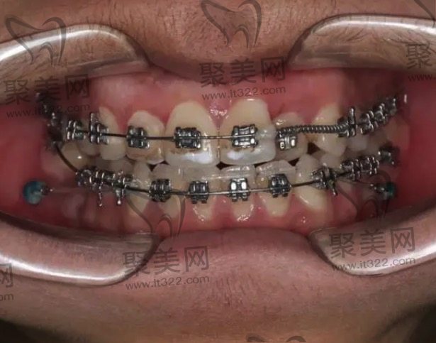 自锁托槽和普通托槽到底选择哪个好? 自锁托槽和普通托槽到底选择哪个好?