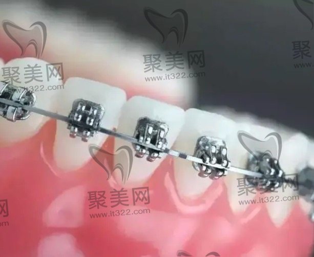 普通金属托槽矫正优缺点和价格分析 普通金属托槽矫正优缺点和价格分析
