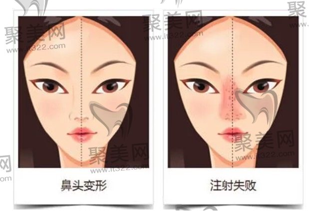 隆鼻失败的情况 隆鼻失败的情况