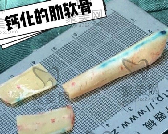 隆鼻修复要多久才能二次修复? 隆鼻修复要多久才能二次修复?