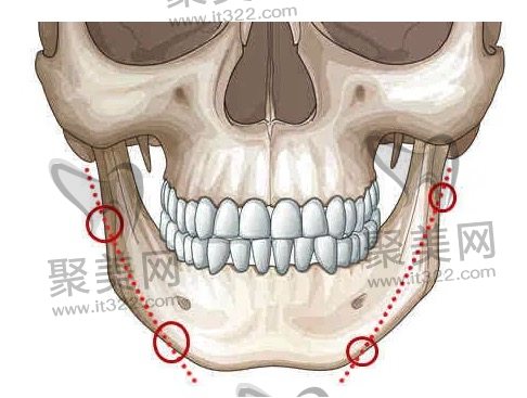 方脸削骨瘦脸风险大吗? 方脸削骨瘦脸风险大吗?