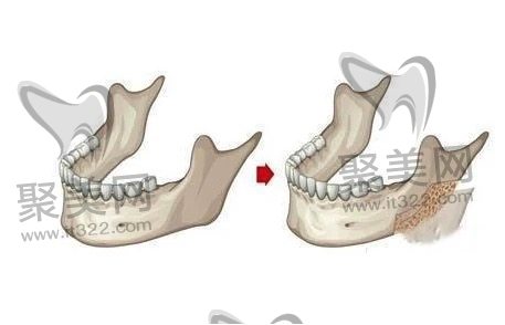 方脸能够通过削骨手术改善吗 方脸能够通过削骨手术改善吗