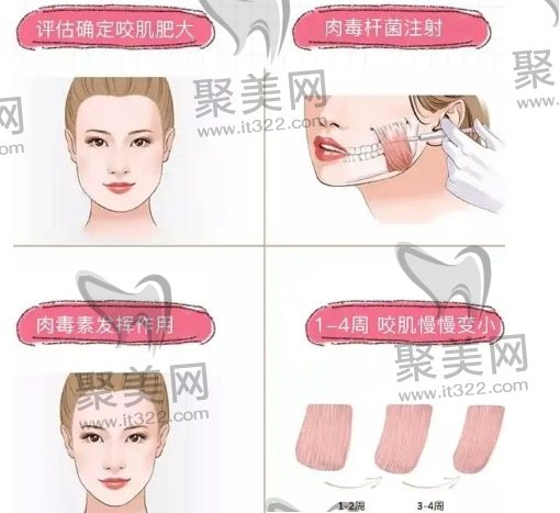 注射瘦脸 注射瘦脸