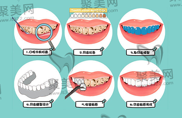 牙齿贴面流程示意 牙齿贴面流程示意