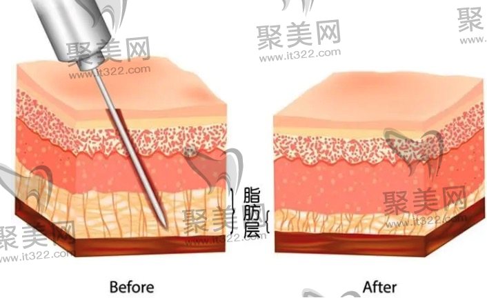 什么是局部抽脂手术? 什么是局部抽脂手术?