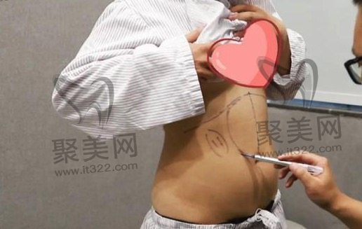 局部抽脂价格贵吗 局部抽脂价格贵吗