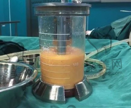 抽出的脂肪 抽出的脂肪