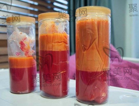 局部抽脂手术价格一览表 局部抽脂手术价格一览表