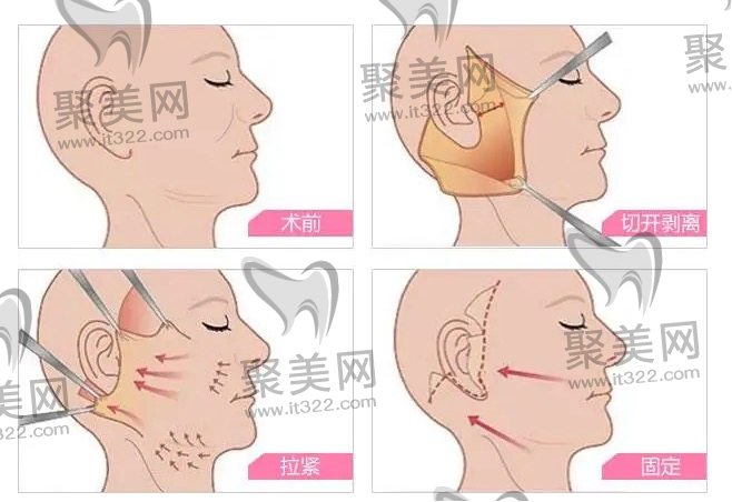 什么是小拉皮和大拉皮手术 什么是小拉皮和大拉皮手术