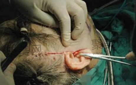 45岁适合做小拉皮还是大拉皮? 45岁适合做小拉皮还是大拉皮?