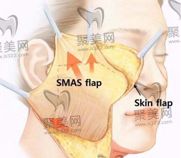 面部拉皮手术多大年龄适合做 面部拉皮手术多大年龄适合做