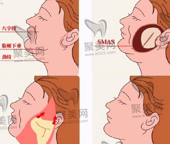 面部拉皮手术的风险和注意事项 面部拉皮手术的风险和注意事项